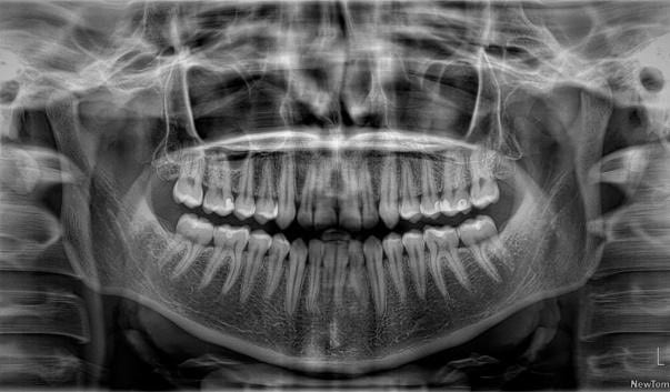 Todo lo que necesitas saber sobre las radiografías dentales Aien